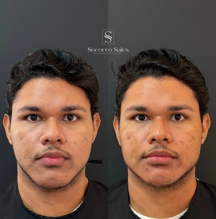 ft-antes-e-depois-1