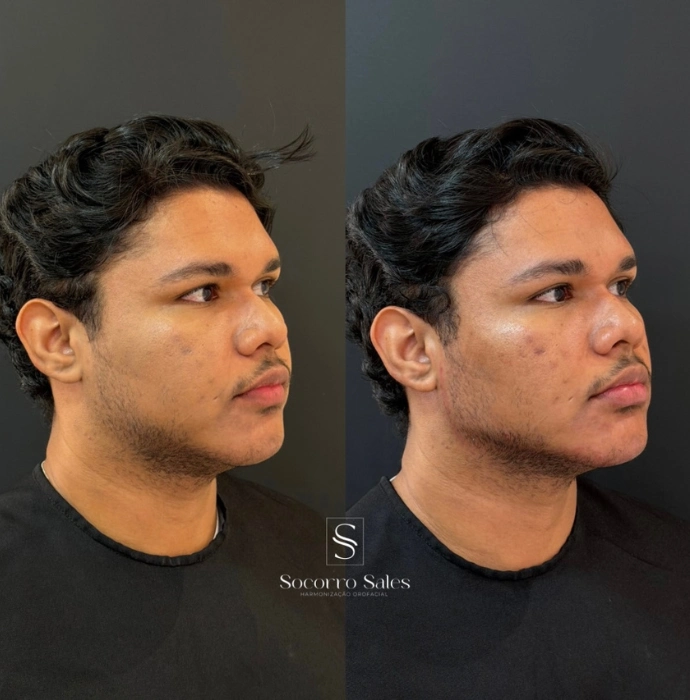 ft-antes-e-depois-2