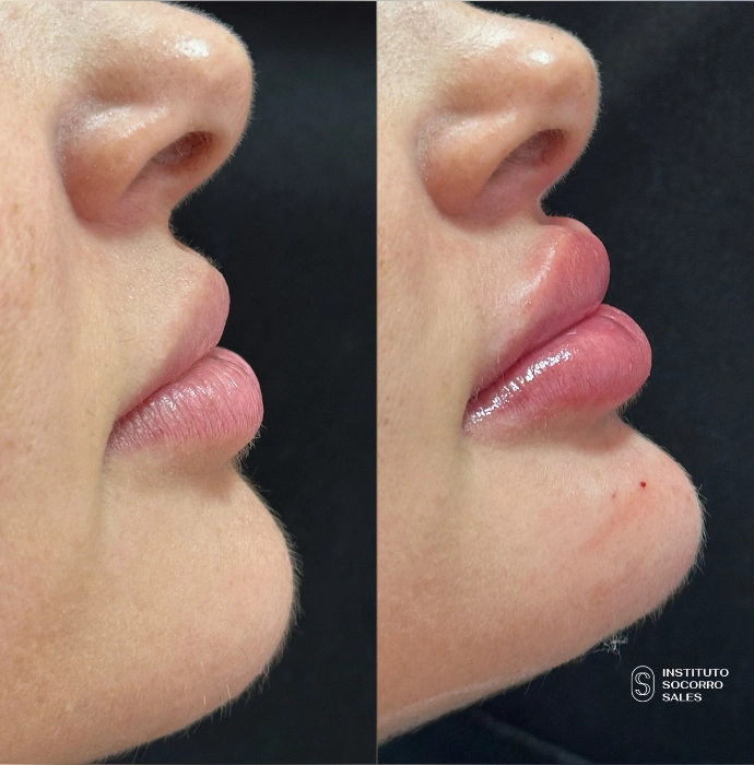 ft-antes-e-depois-4