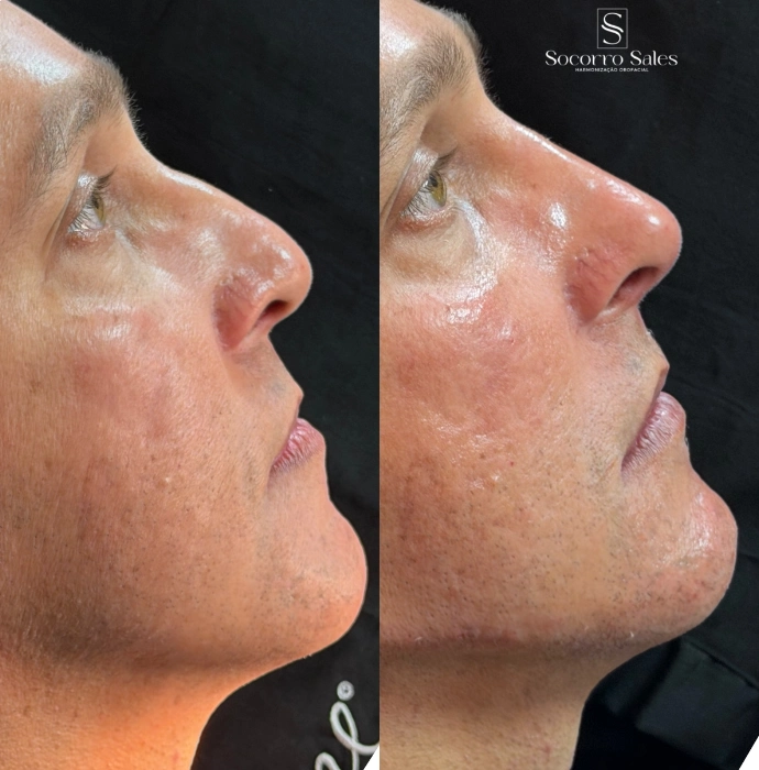 ft-antes-e-depois-5