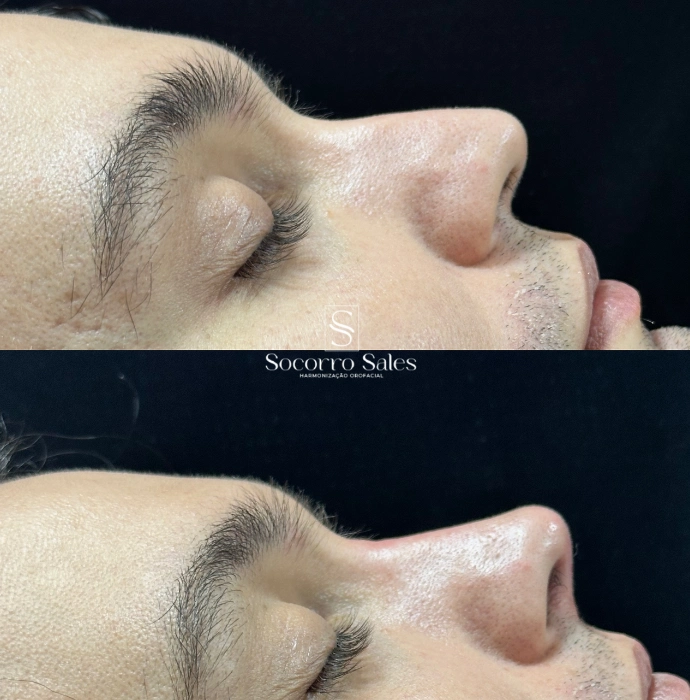 ft-antes-e-depois-6