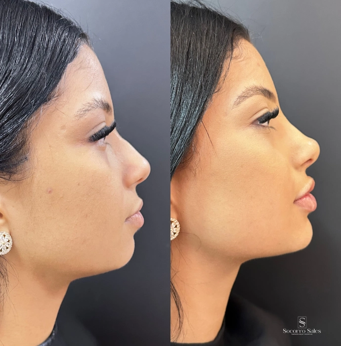 ft-antes-e-depois-7